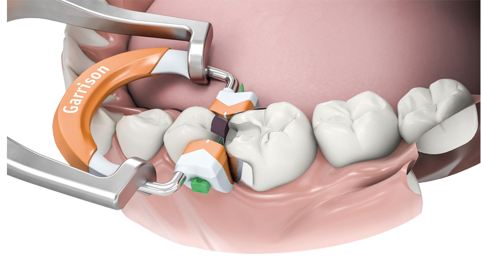 Garrison Dental | Composi-Tight® 3D Fusion™