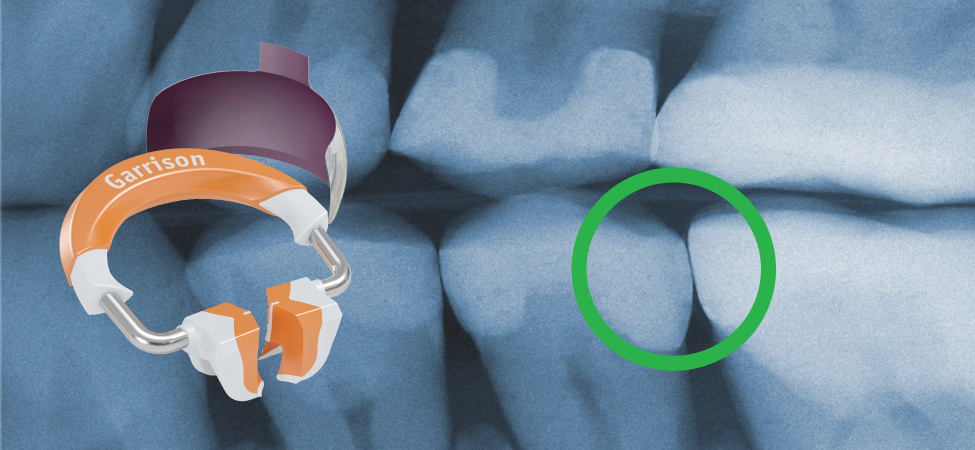 Composi-Tight® Sectional Matrix System