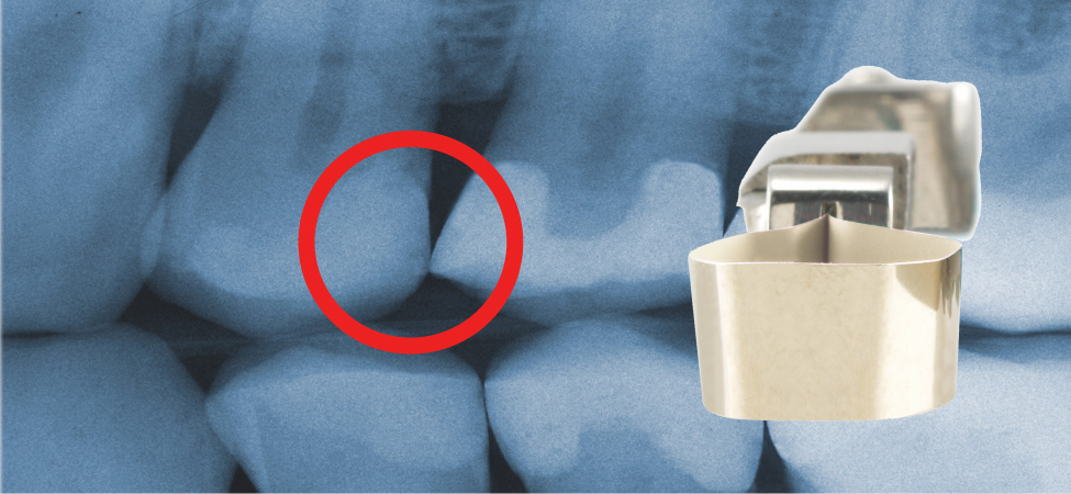 Tofflemire-style System