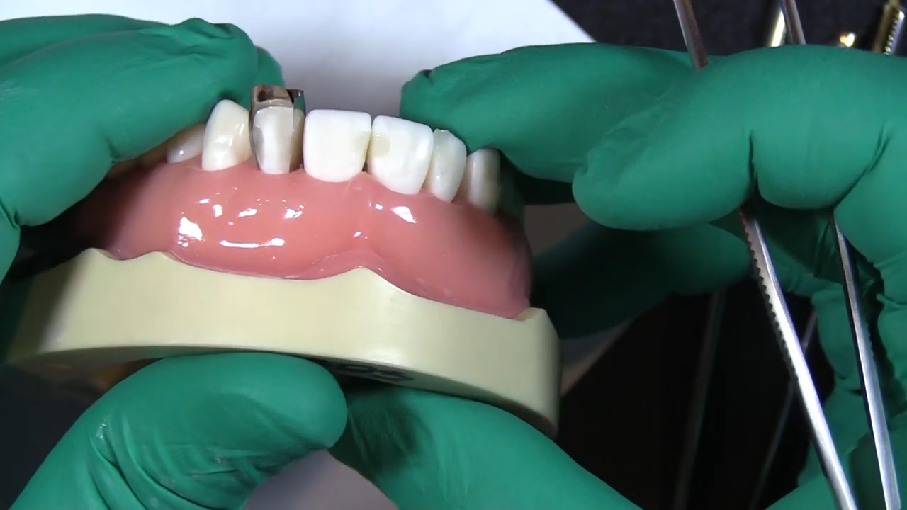 Two stacked Fusion Anterior Matrix Bands