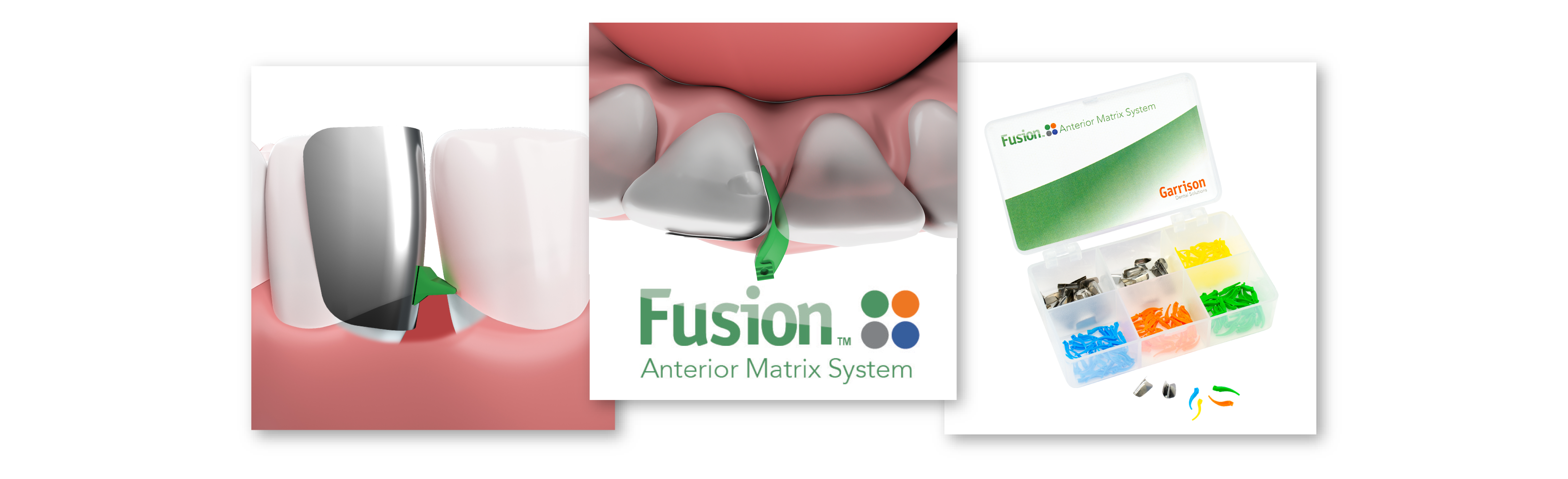 Fusion Anterior Matrix System Image for Landing Pages
