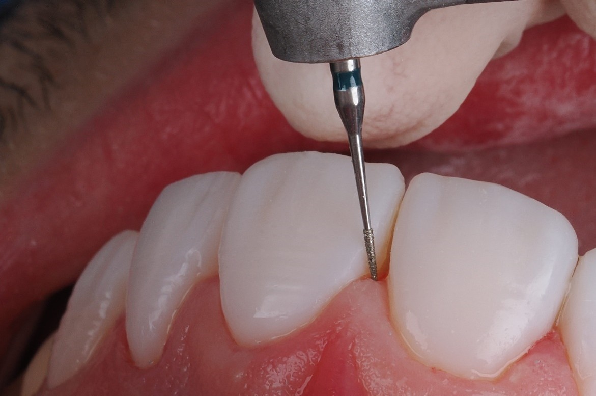 ProxiBur™ PRXR02M&nbsp;Being Used for a Flowable Injection Molding Anterior Case