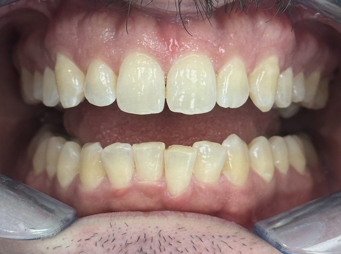 Kaplan - ProxiBur for IPR During Invisalign Treatment