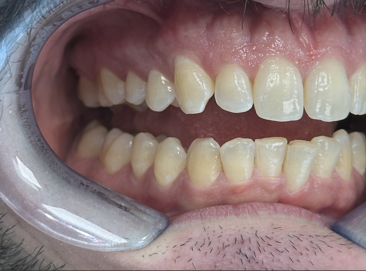 Kaplan - ProxiBur for IPR During Invisalign Treatment