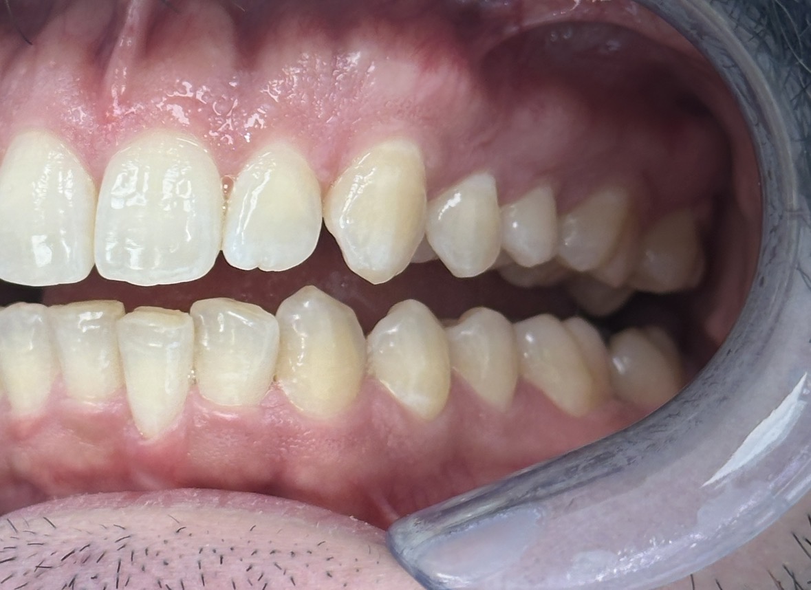 Kaplan - ProxiBur for IPR During Invisalign Treatment