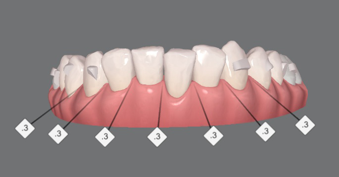 Kaplan - ProxiBur for IPR During Invisalign Treatment