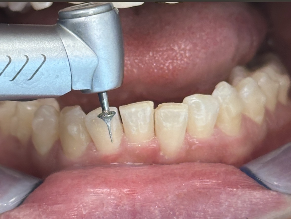 Kaplan - ProxiBur for IPR During Invisalign Treatment