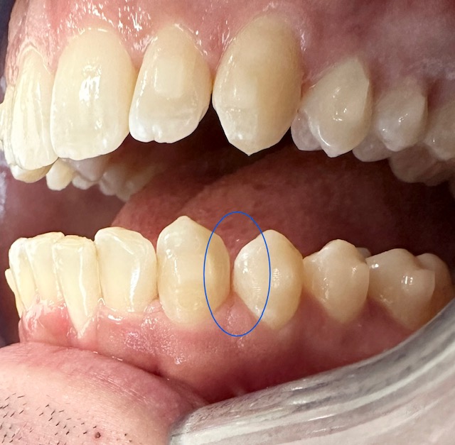 Kaplan - ProxiBur for IPR During Invisalign Treatment