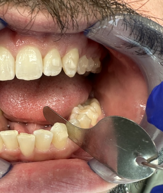 Kaplan - ProxiBur for IPR During Invisalign Treatment