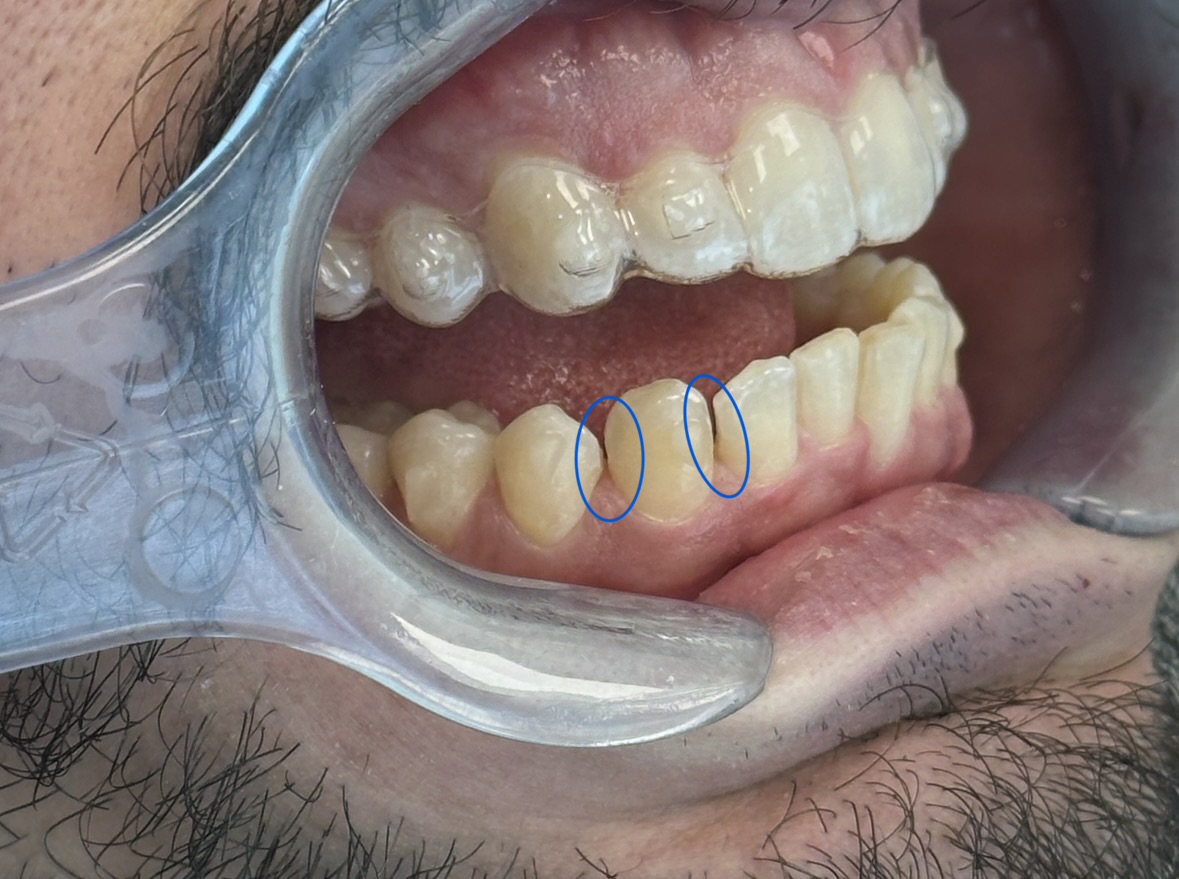 Kaplan - ProxiBur for IPR During Invisalign Treatment