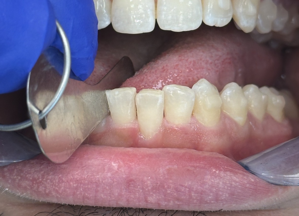 Kaplan - ProxiBur for IPR During Invisalign Treatment