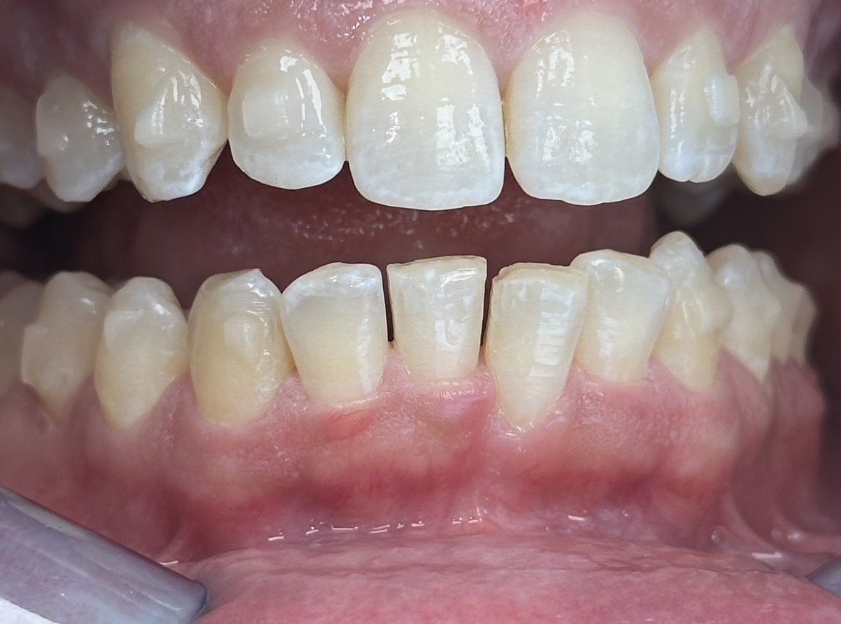 Kaplan - ProxiBur for IPR During Invisalign Treatment