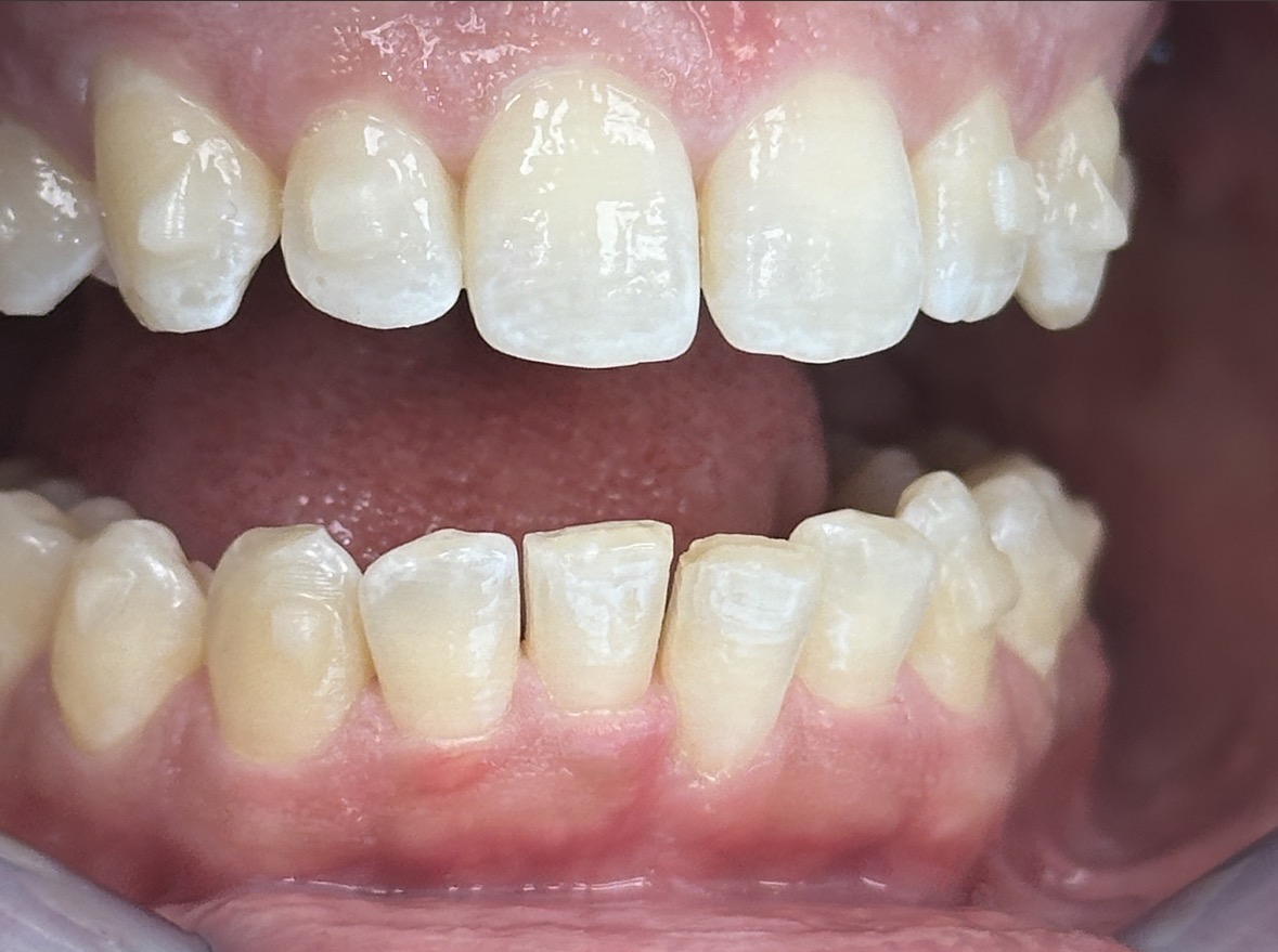 Kaplan - ProxiBur for IPR During Invisalign Treatment