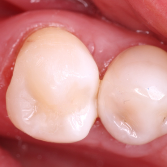 Naranjo-Simplifying Class IIs without an adjacent tooth ReelMatrix - image