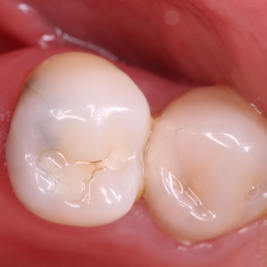 Naranjo-Simplifying Class IIs without an adjacent tooth ReelMatrix - image