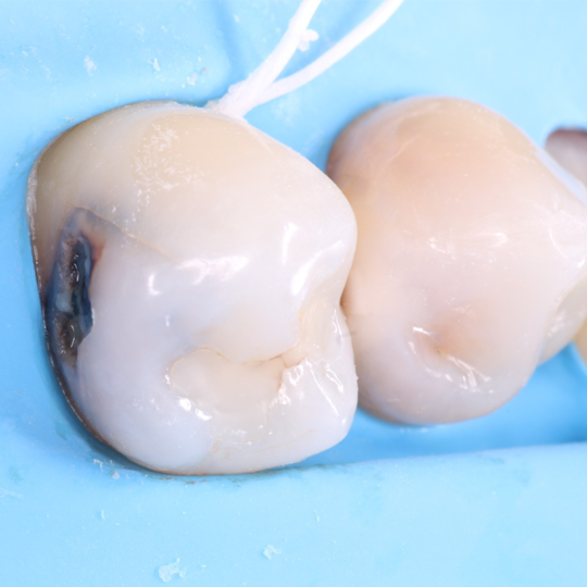 Naranjo-Simplifying Class IIs without an adjacent tooth ReelMatrix - image