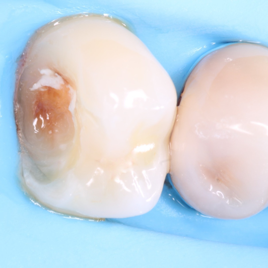 Naranjo-Simplifying Class IIs without an adjacent tooth ReelMatrix - image