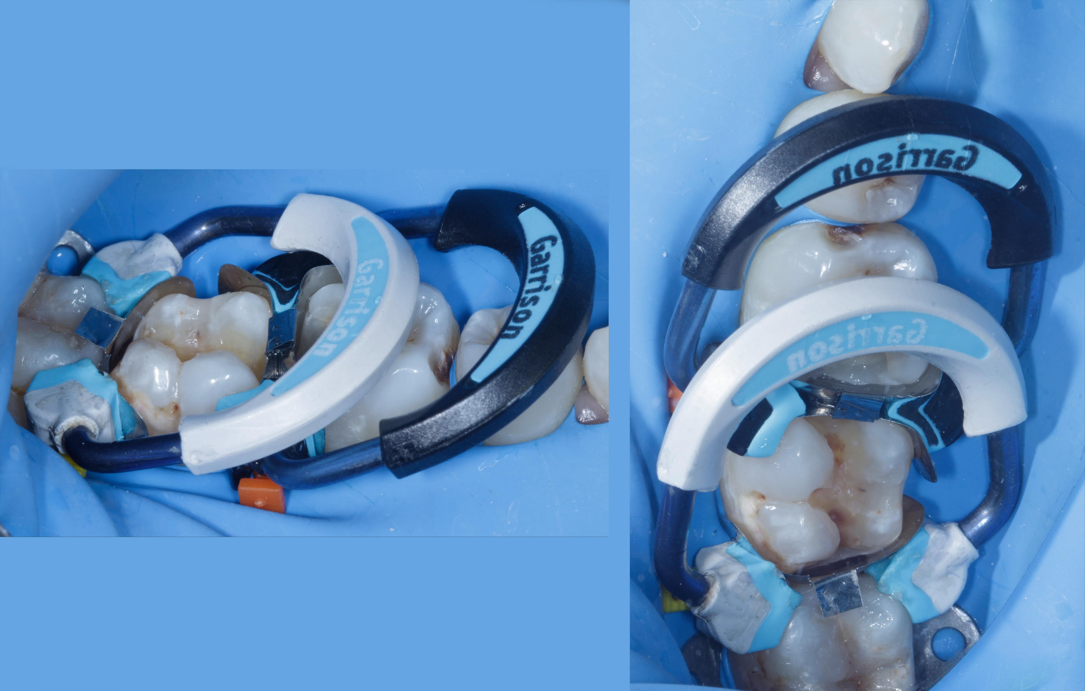 A Minimally Invasive Strategy for Restoring Complex MOD Defects with ...