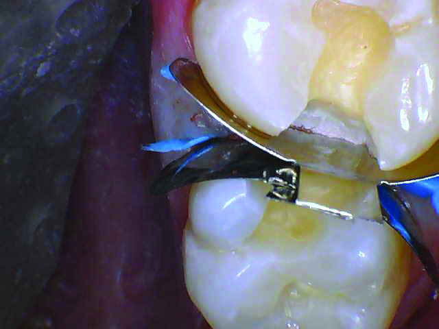 RomeneskoNick_Band and wedge 2 (2)_012325 Figure 5b