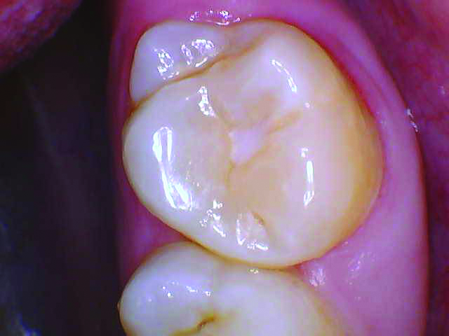 RomeneskoNick_Preop 2_013025 Figure 2