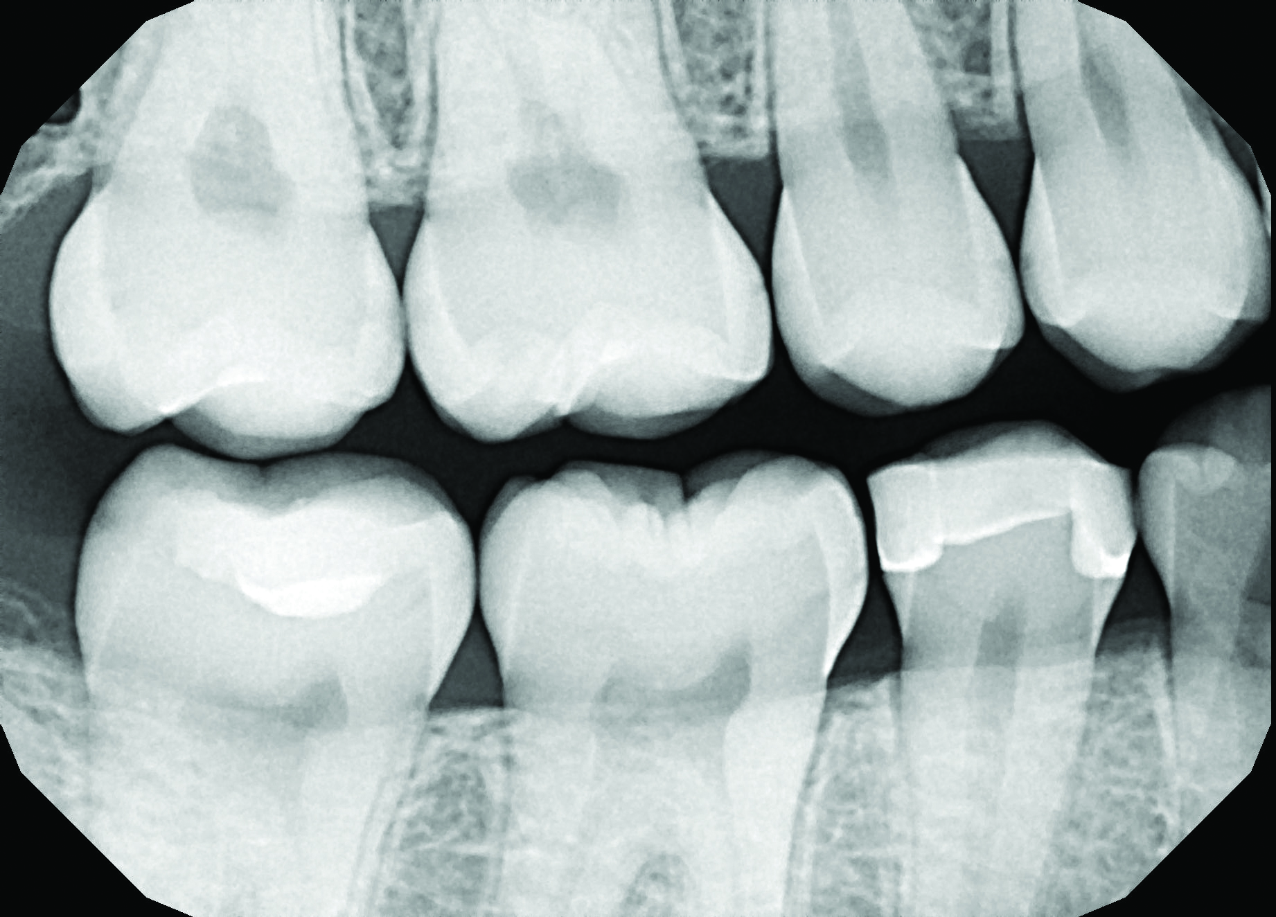 RomeneskoNick_Preop radiograph_013025 Figure 1