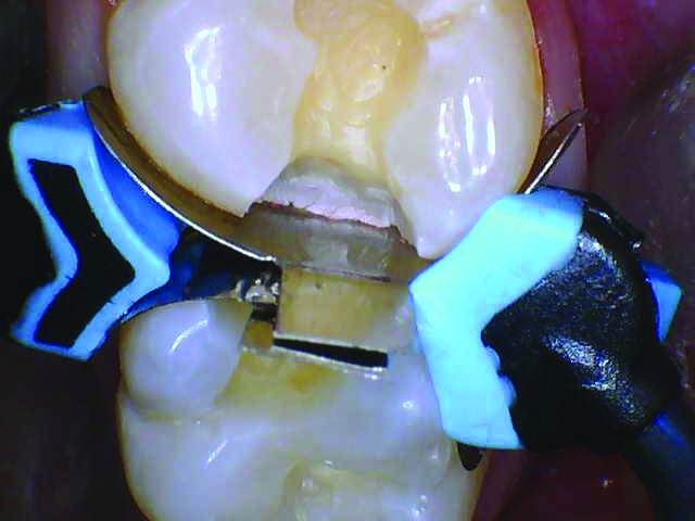 RomeneskoNick_Ring on 2_013025 Figure 6a