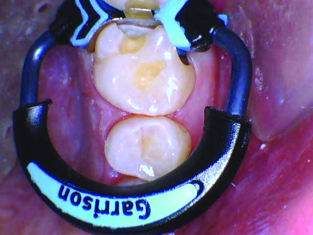 RomeneskoNick_Ring on 3_013025 Figure 6b