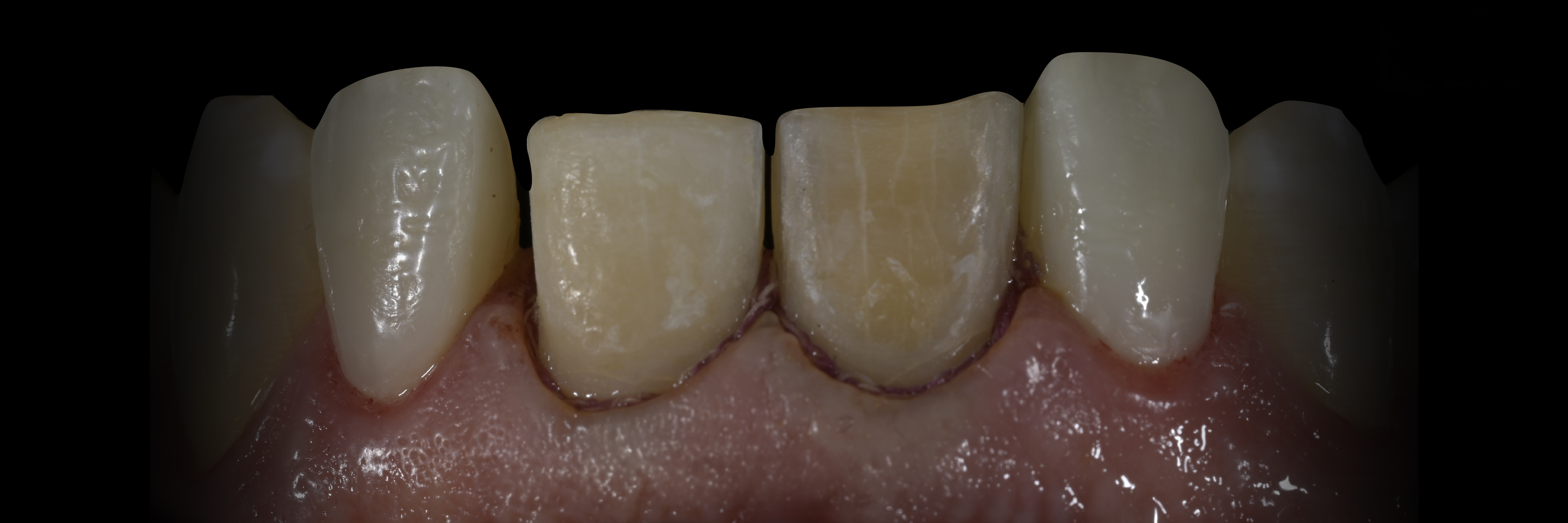Sommella Using FitStrip Diamond Abrasive Strips images