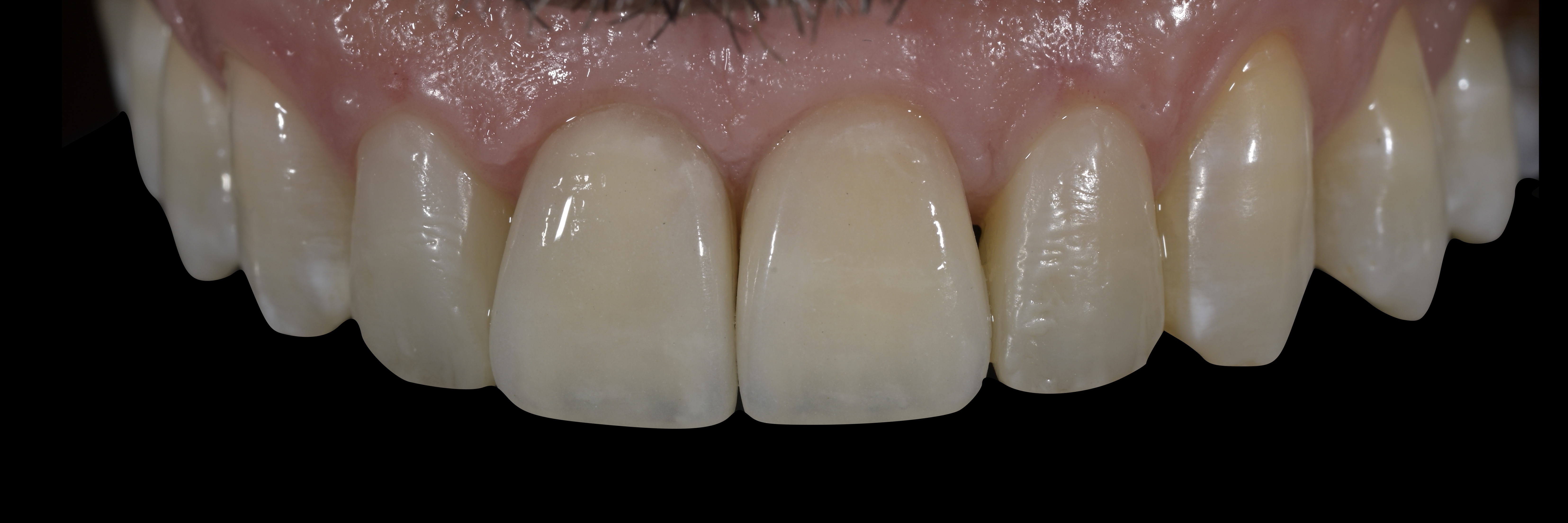 Sommella Using FitStrip Diamond Abrasive Strips images