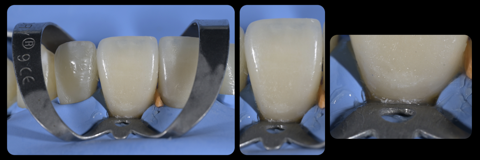 Sommella Using FitStrip Diamond Abrasive Strips images