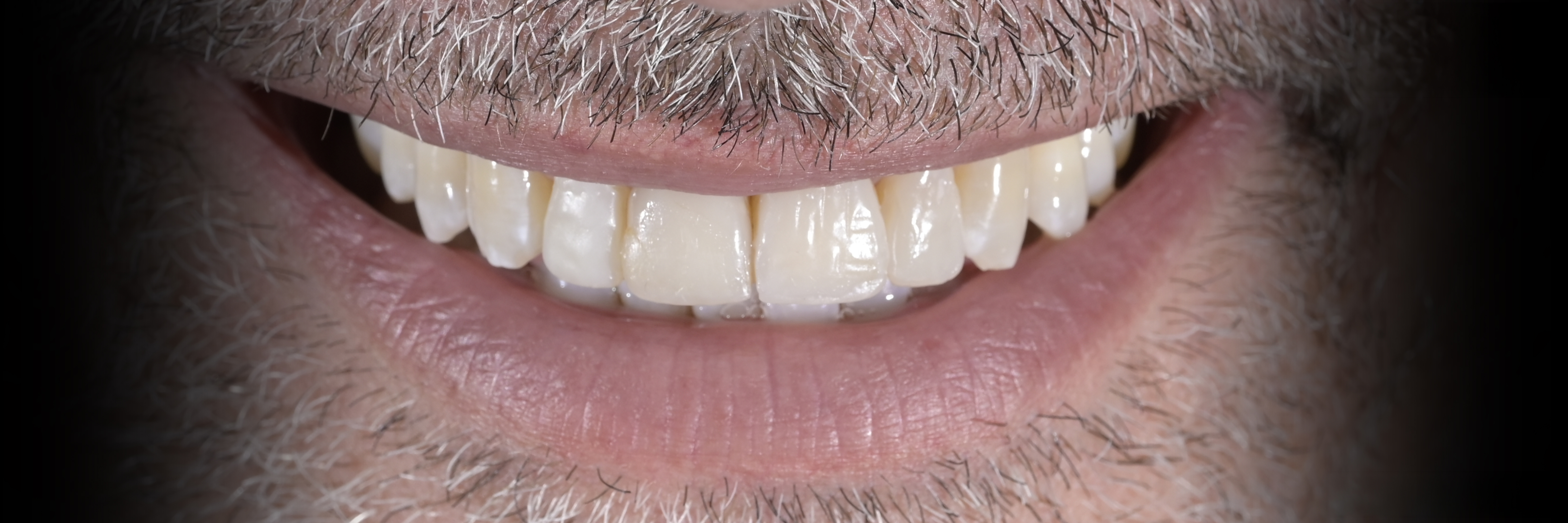 Sommella Using FitStrip Diamond Abrasive Strips images