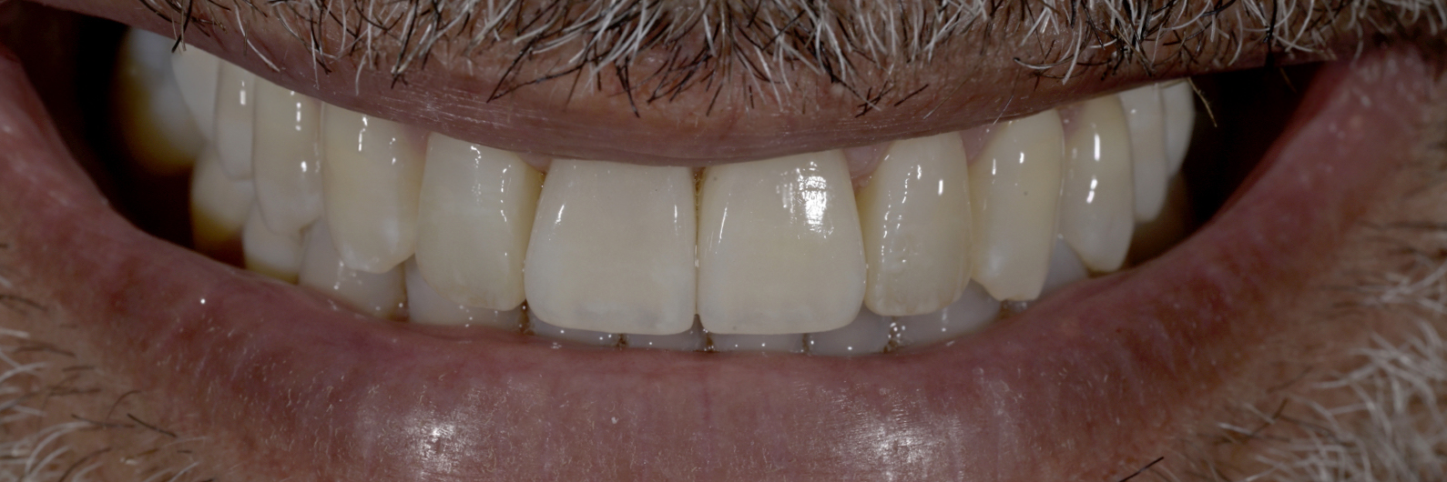Sommella Using FitStrip Diamond Abrasive Strips images