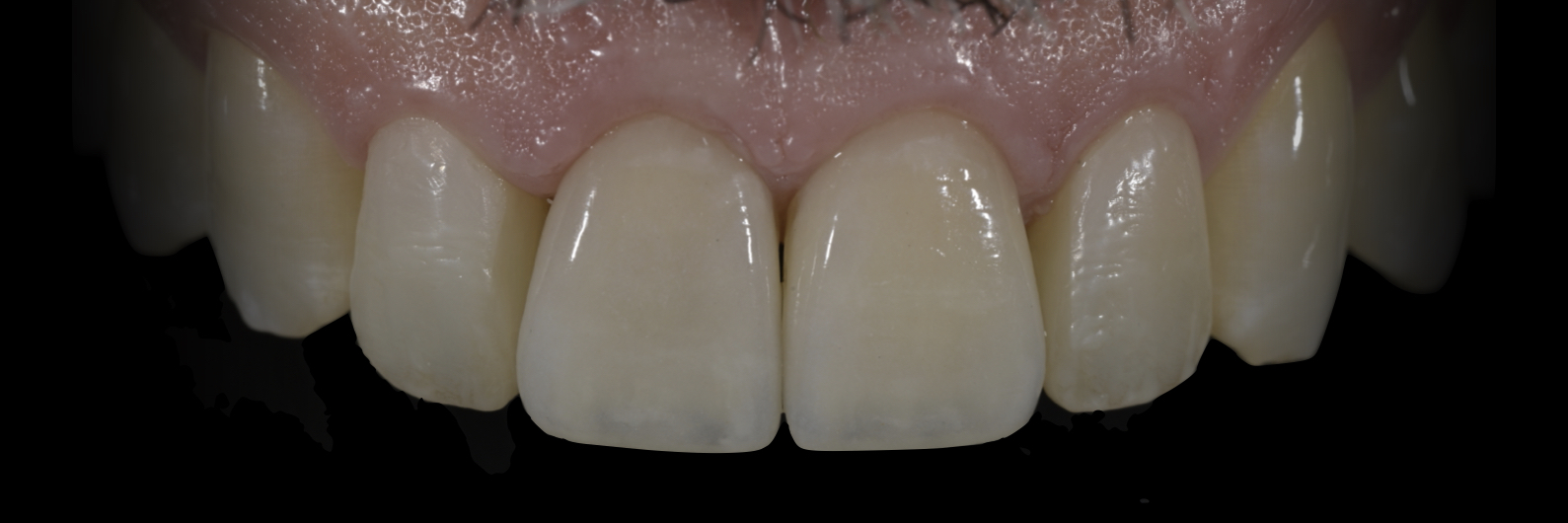 Sommella Using FitStrip Diamond Abrasive Strips images