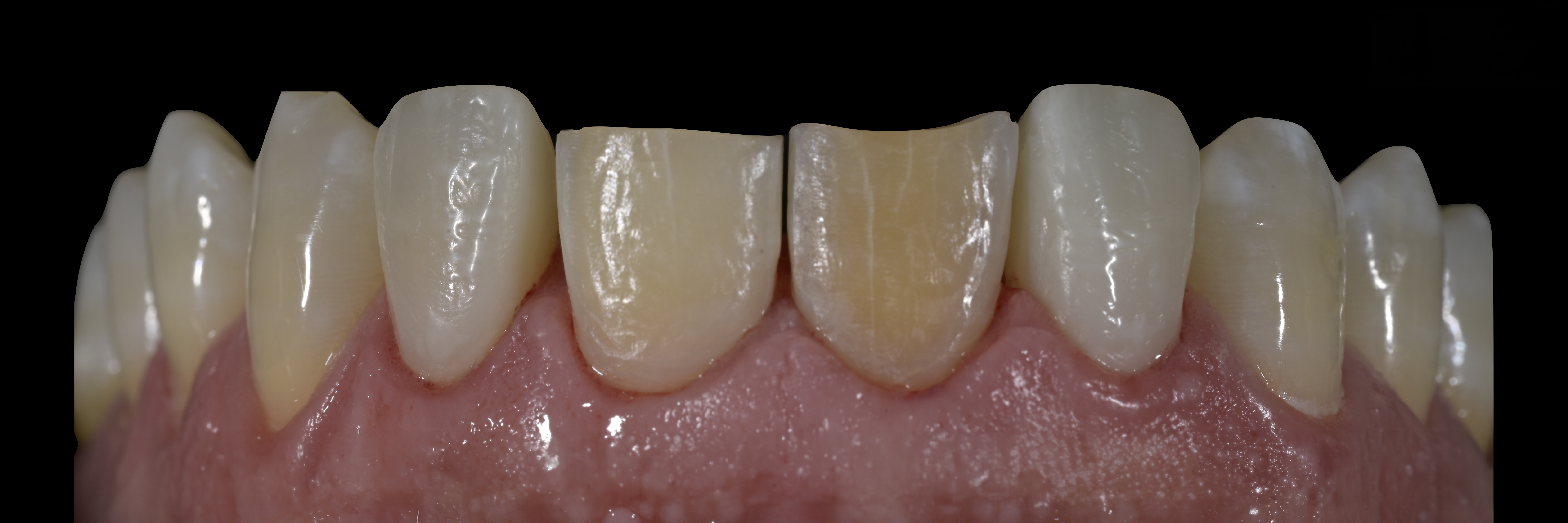 Sommella Using FitStrip Diamond Abrasive Strips images