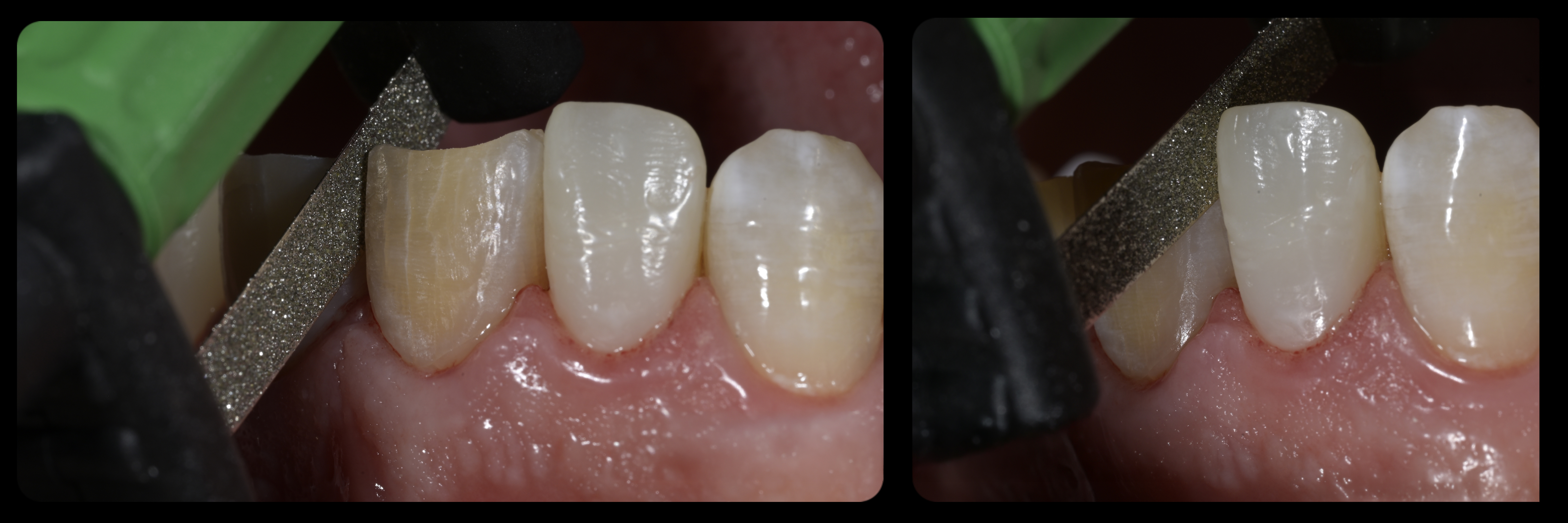 Sommella Using FitStrip Diamond Abrasive Strips images