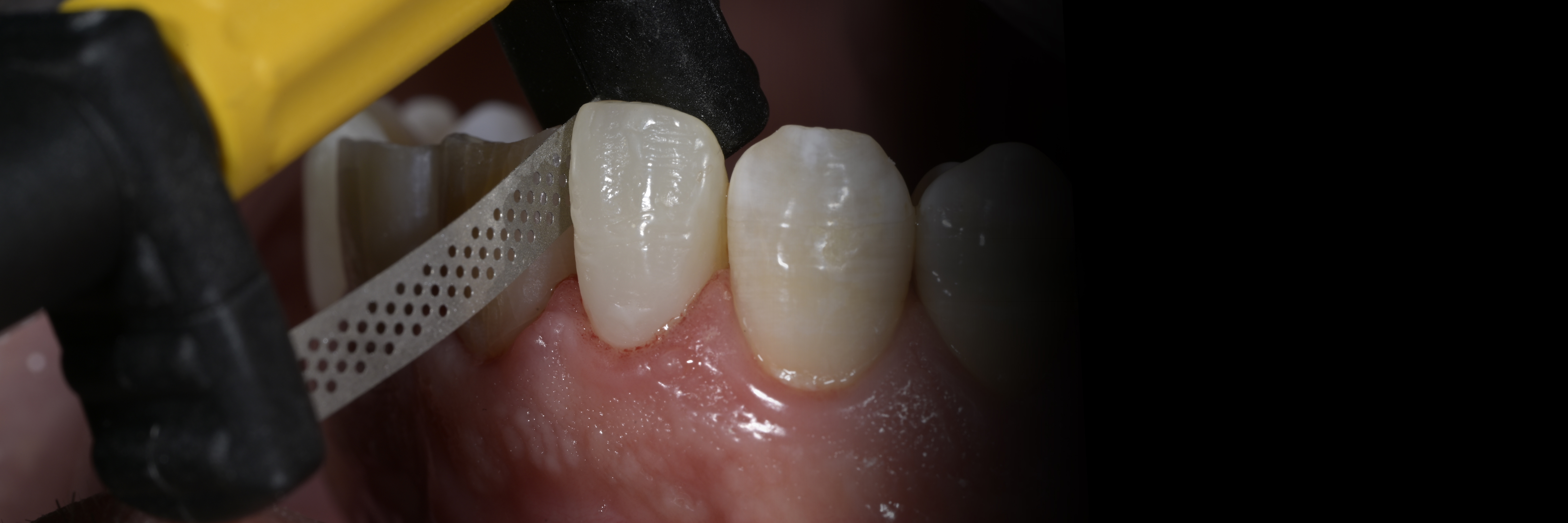 Sommella Using FitStrip Diamond Abrasive Strips images