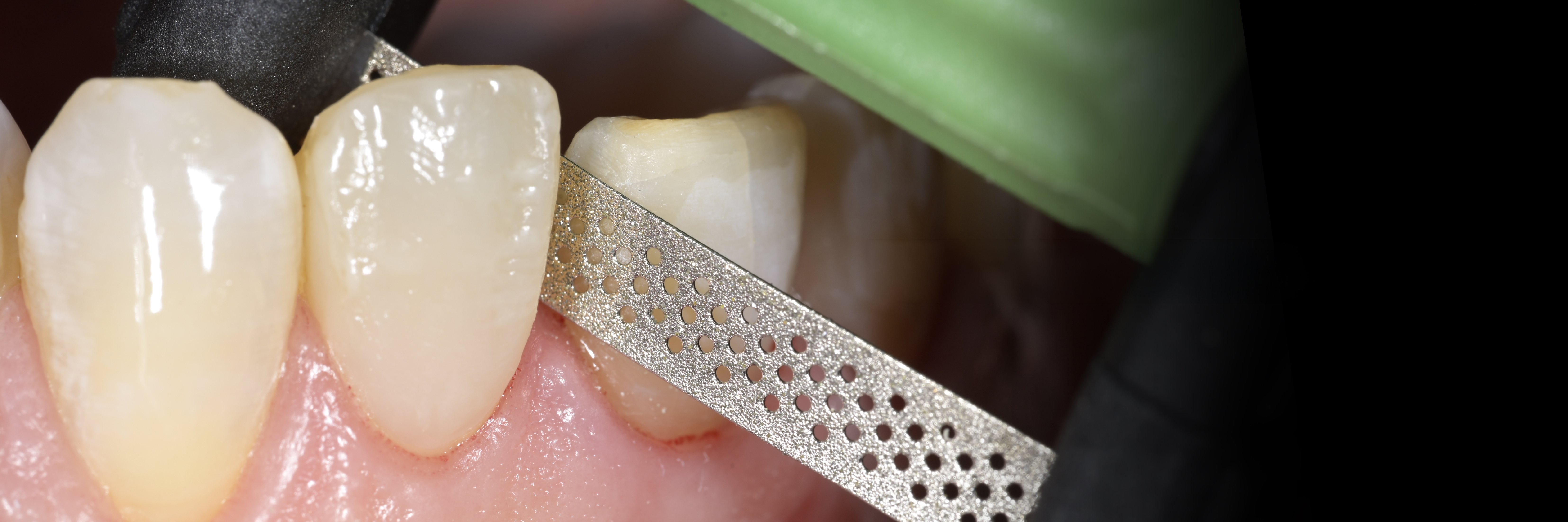 Sommella Using FitStrip Diamond Abrasive Strips images
