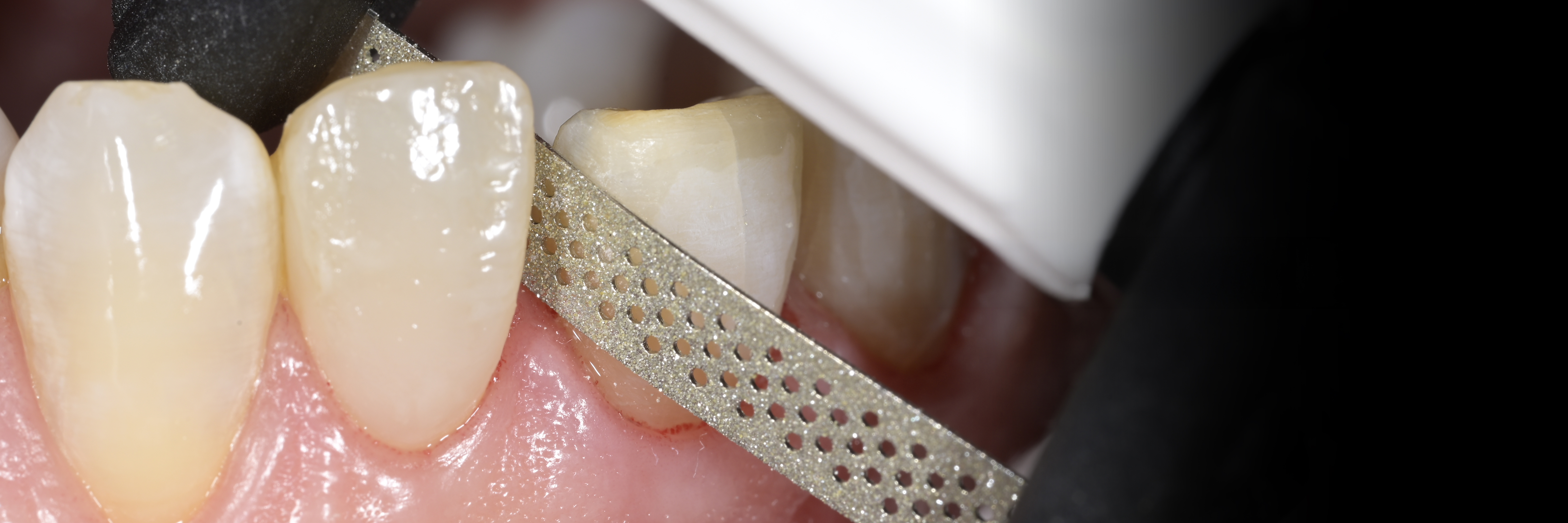 Sommella Using FitStrip Diamond Abrasive Strips images