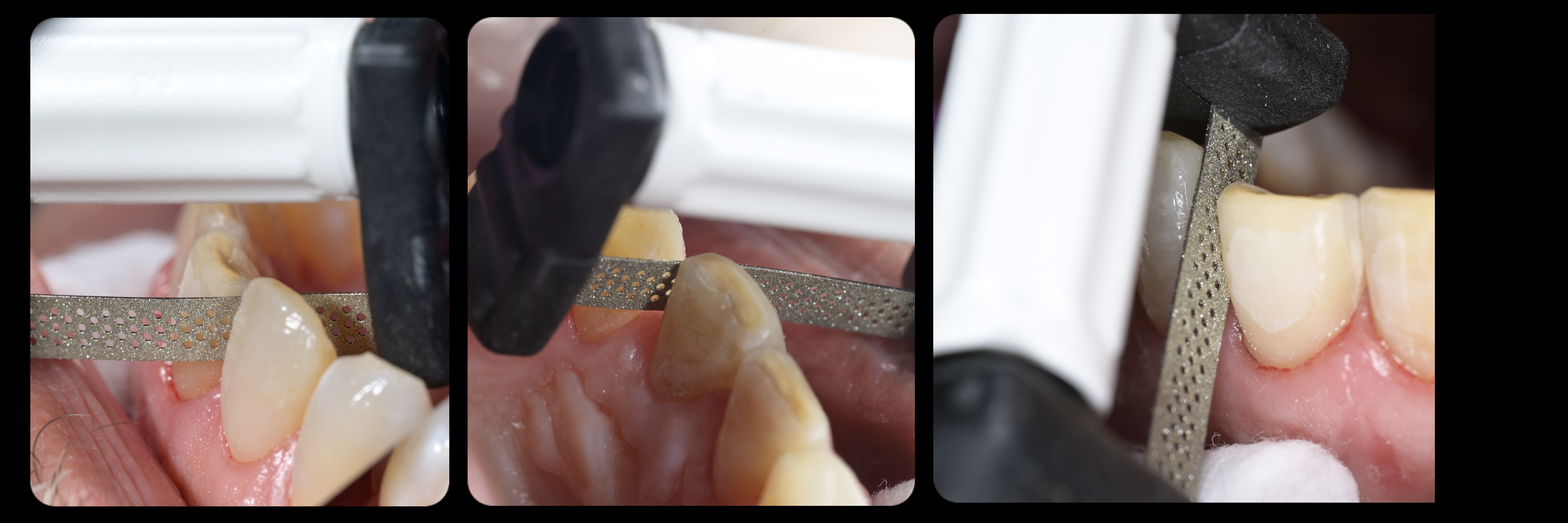 Sommella-Post Cementation Image