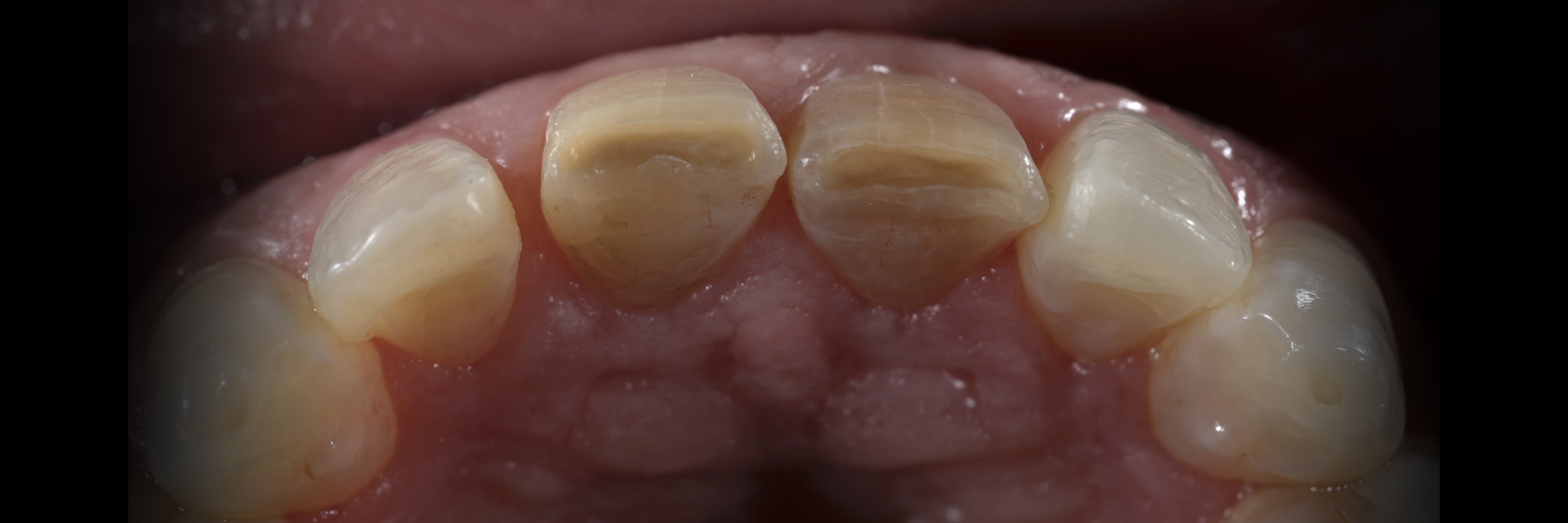 Sommella Using FitStrip Diamond Abrasive Strips images