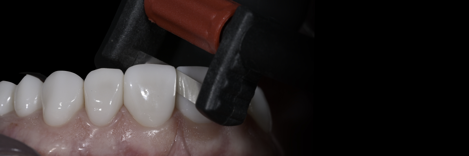 Sommella-Post Cementation Image