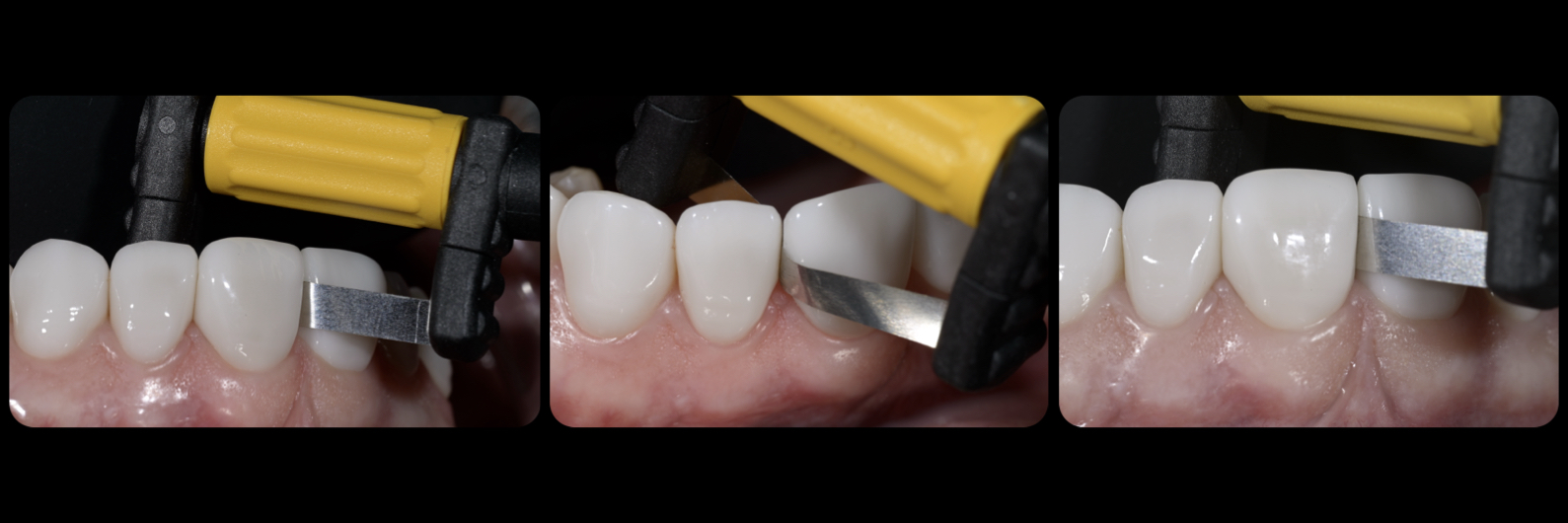 Sommella-Post Cementation Image