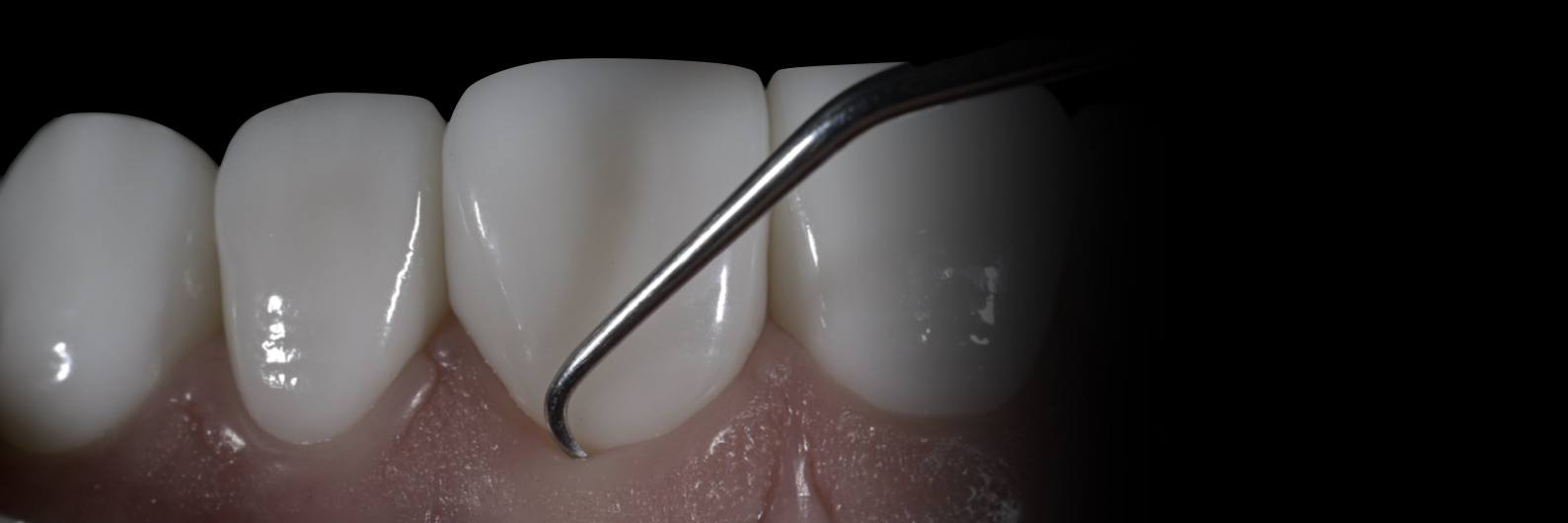 Sommella-Post Cementation Image