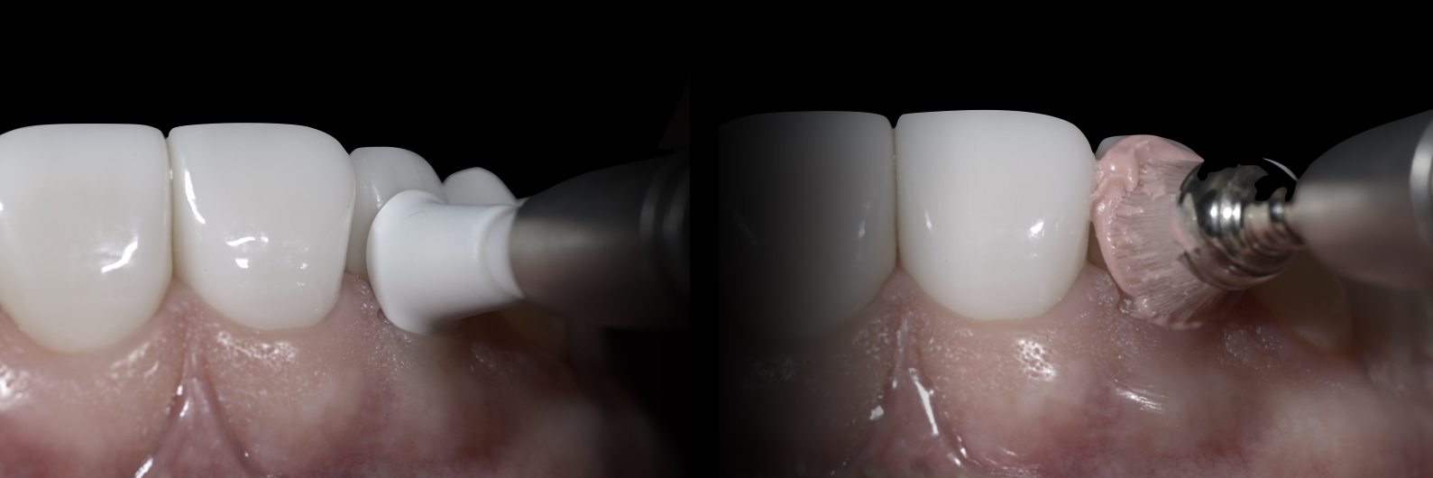 Sommella-Post Cementation Image