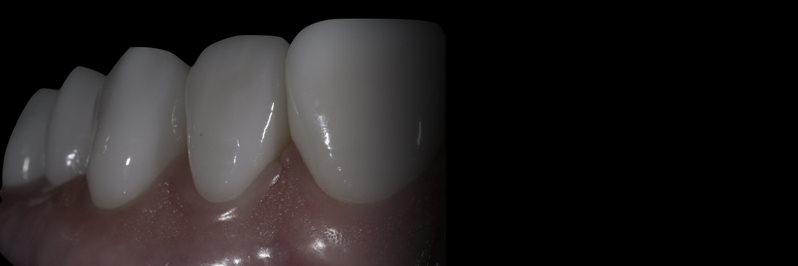 Sommella-Post Cementation Image