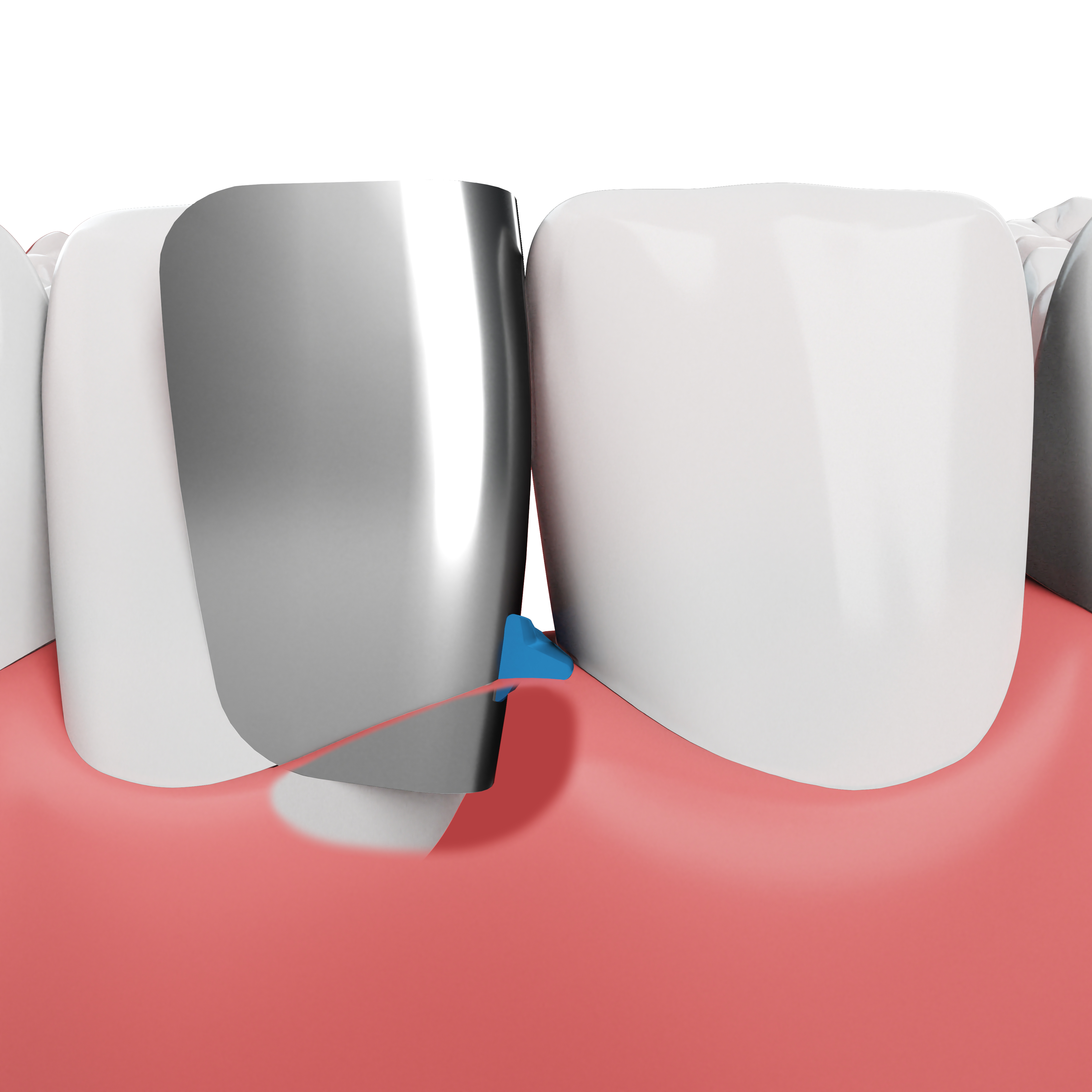 Anterior teeth cutaway