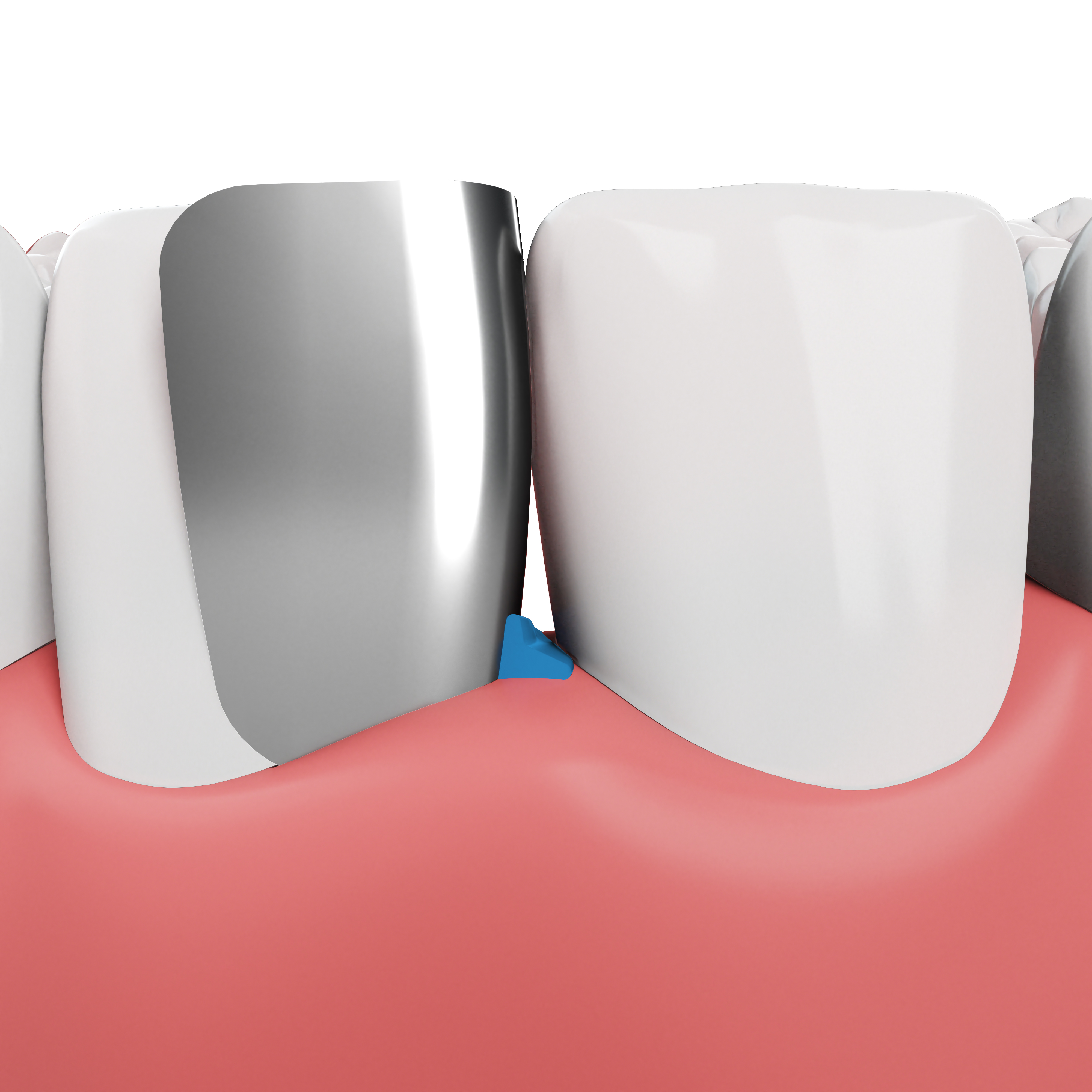 Anterior teeth solid