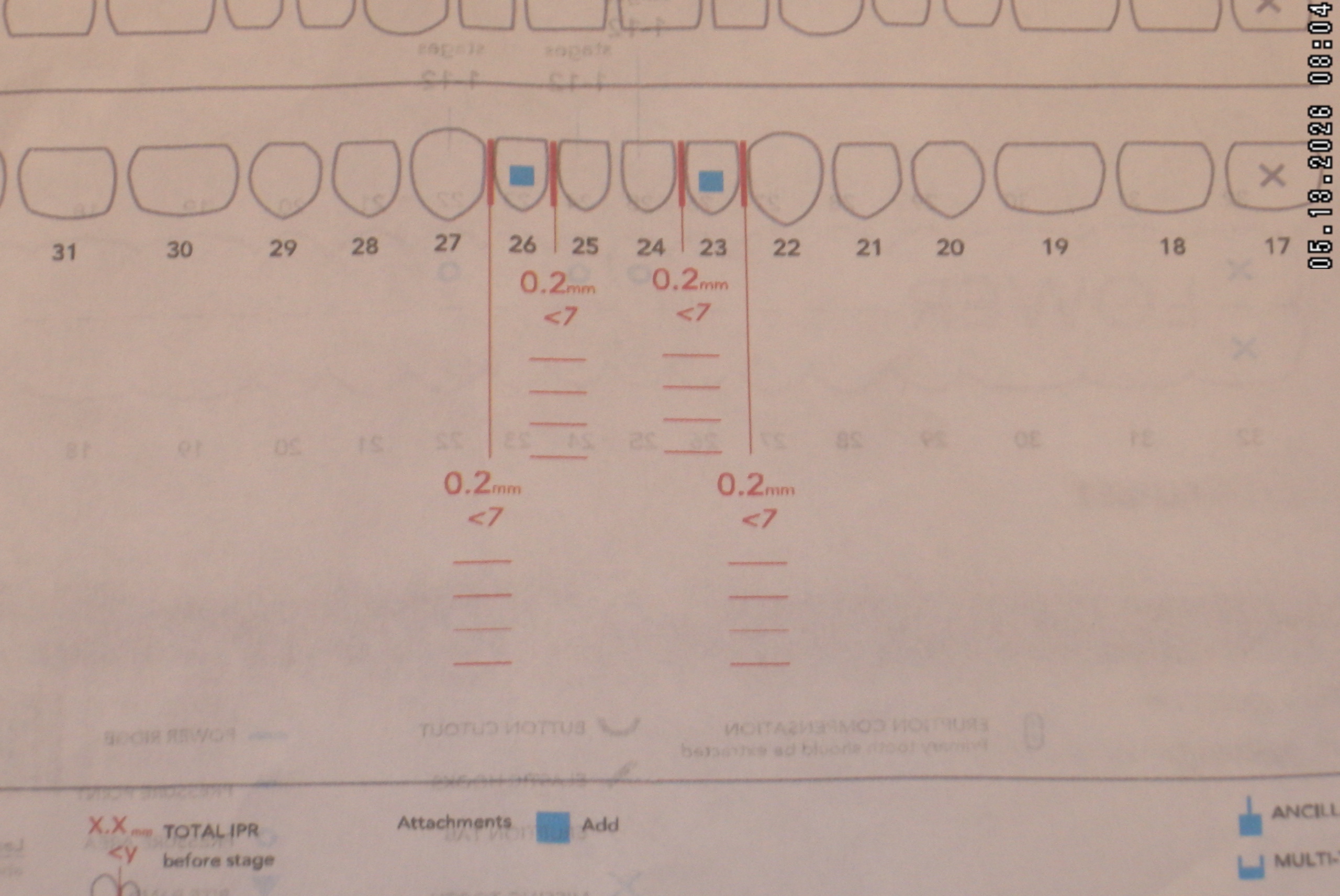 Watson-ProxiBur for Clear Aligner Treatment-image