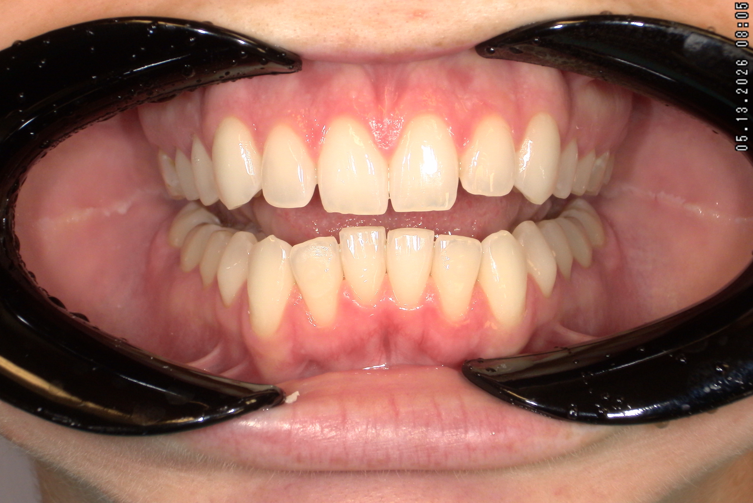 Watson-ProxiBur for Clear Aligner Treatment-image