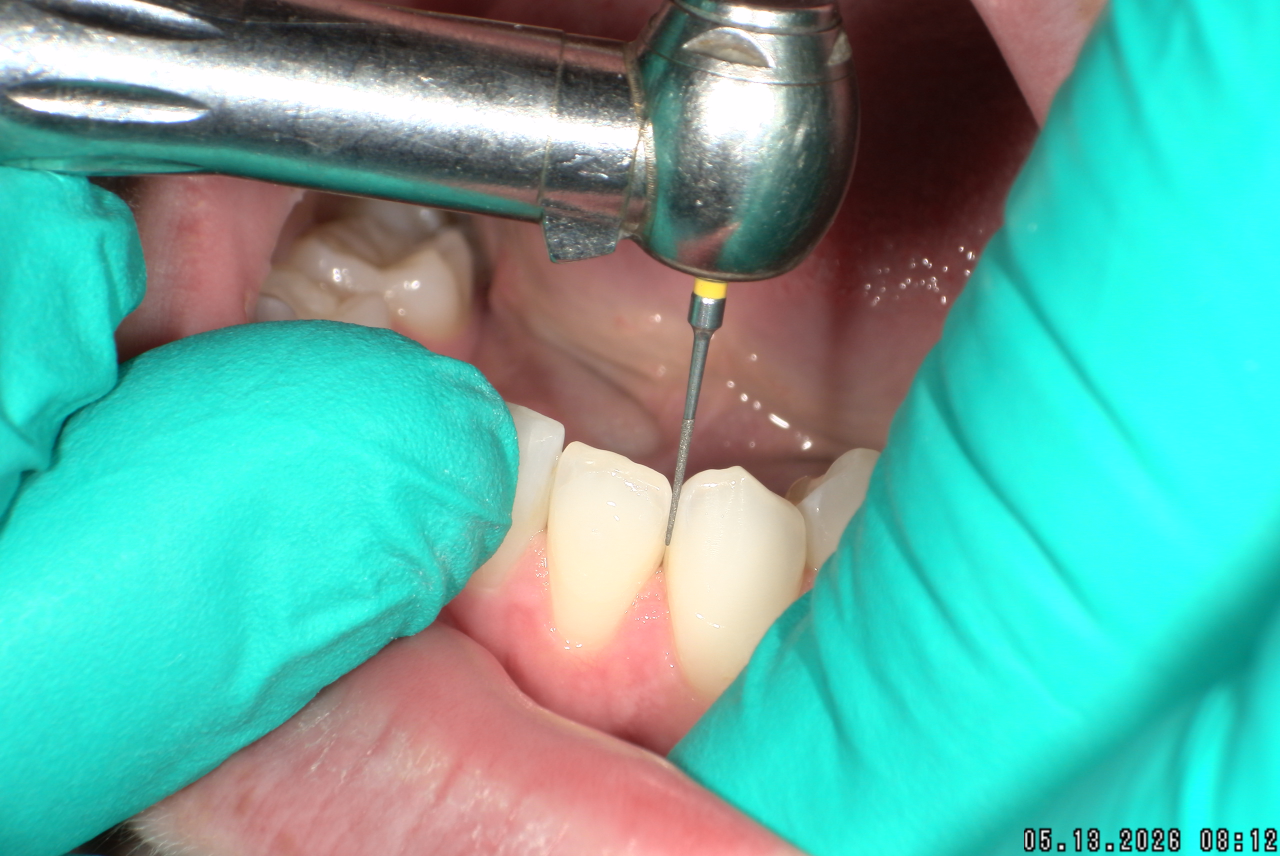 Watson-ProxiBur for Clear Aligner Treatment-image
